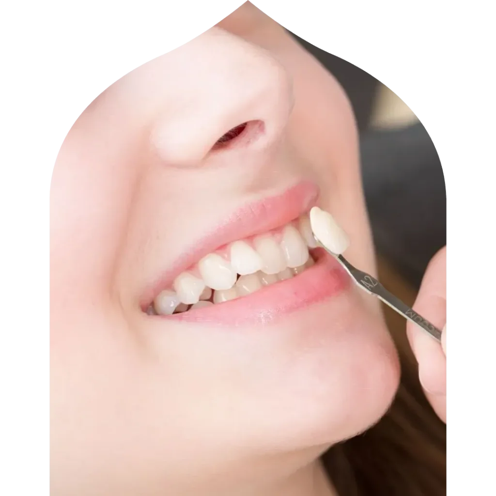Dental Veneers 1 Dental veneers in Ras Al Khaimah