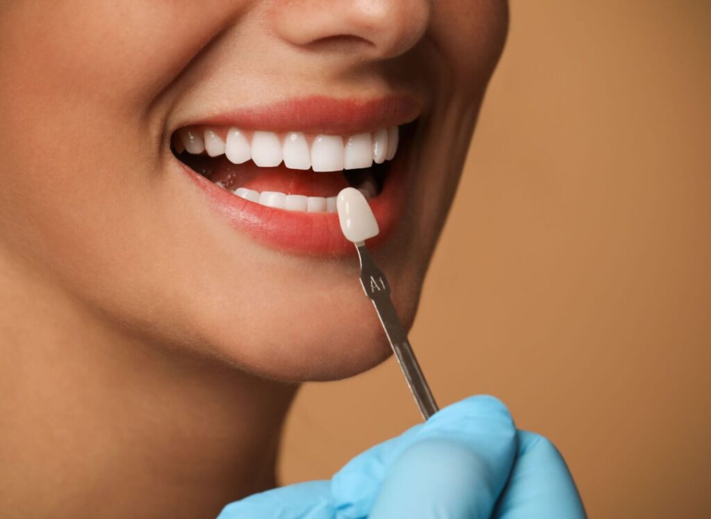 Can Veneers fix Overbite? When Veneers may improve the smile 1 Can Veneers Fix Overbite