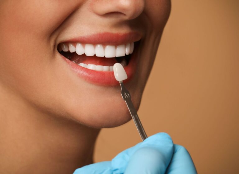 Can Veneers Fix Overbite