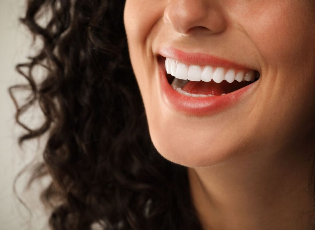 Can Veneers Be Whitened