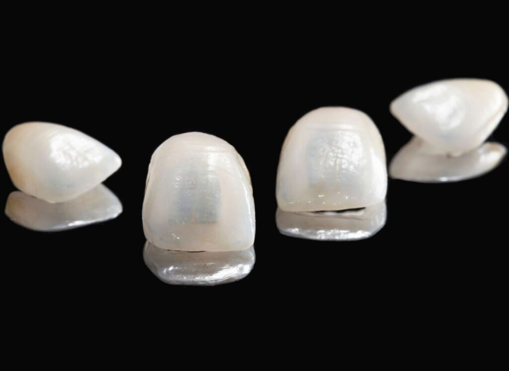 How long do Porcelain Veneers last? How long Dental Veneers really last 1 How Long Do Porcelain Veneers Last