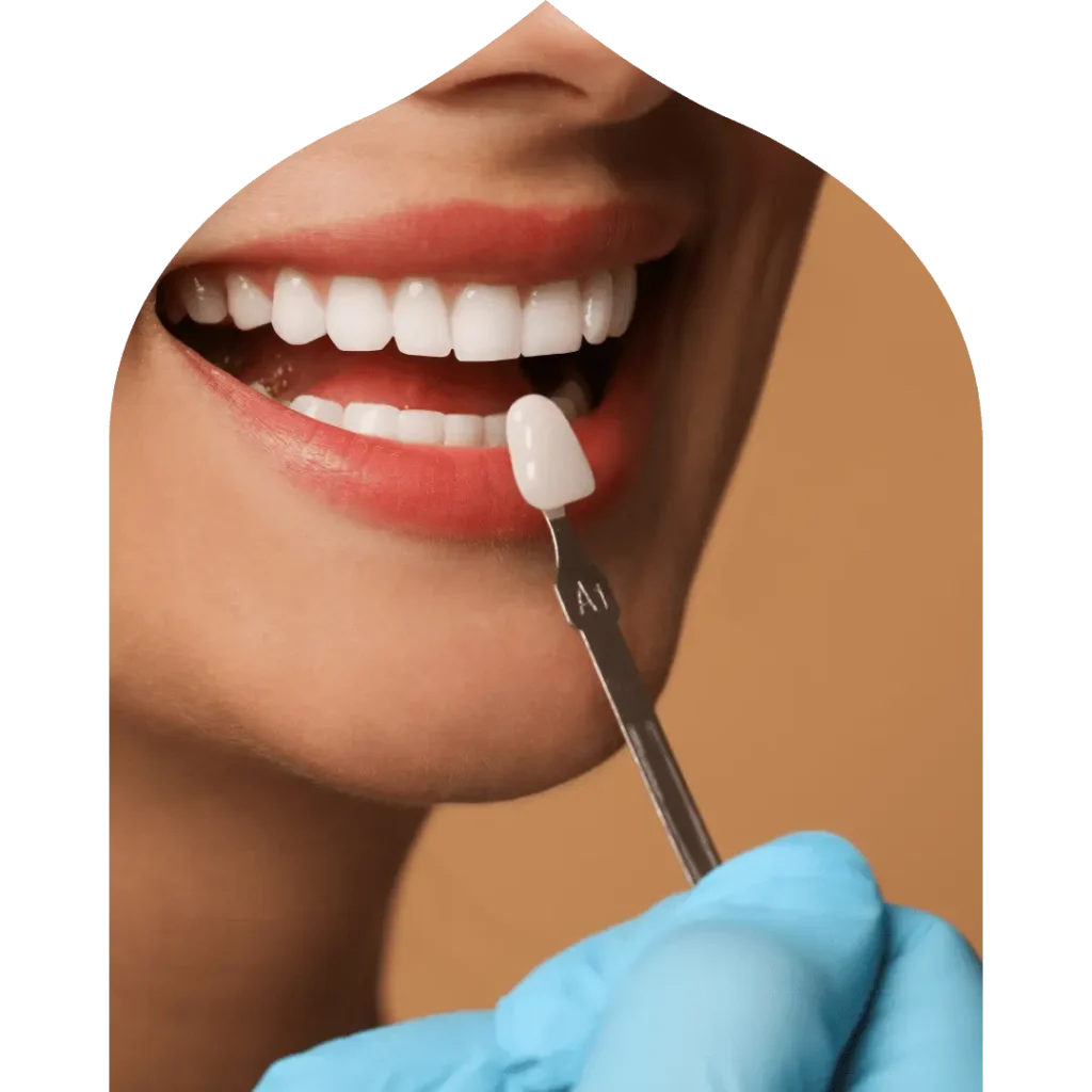 dental veneers in Ras Al Khaimah