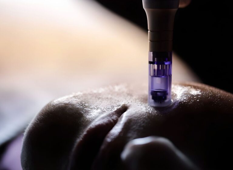 How Many Sessions Of Microneedling Do You Need