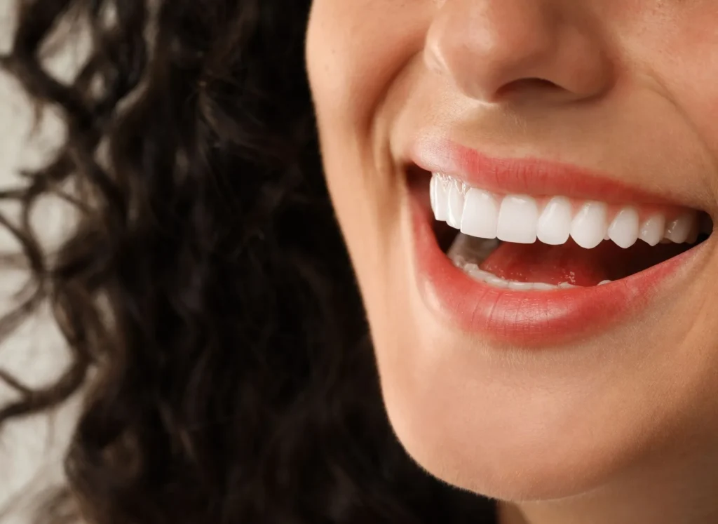Dental Veneers 2 dental veneers in Ras Al Khaimah