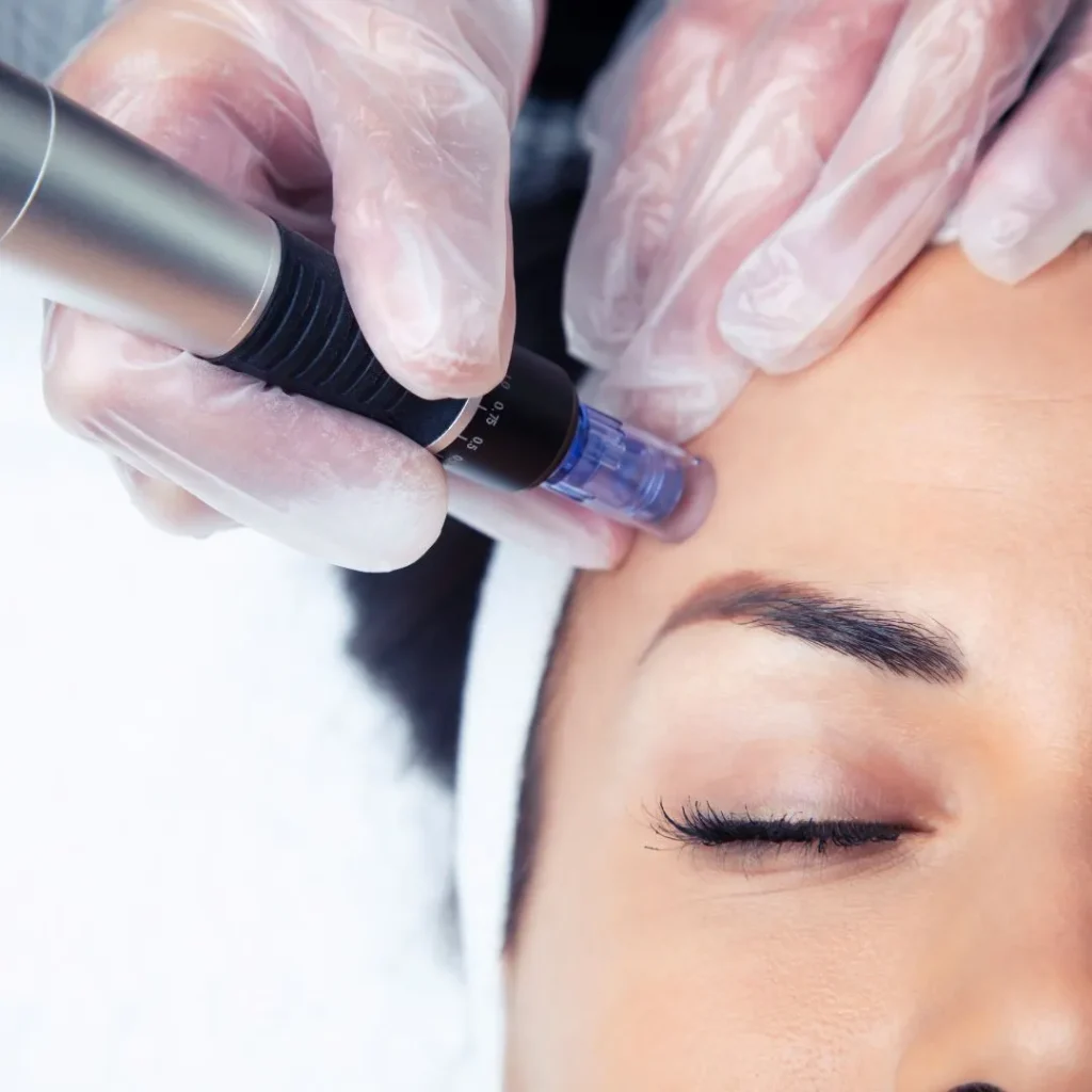 Microneedling 1 microneedling in Ras Al Khaimah